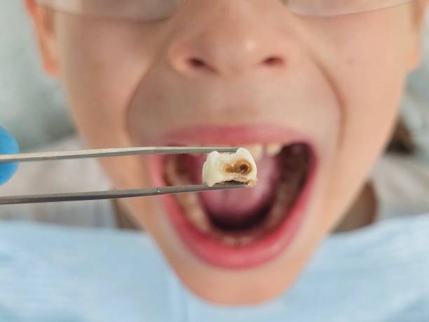 Best Emergency Wisdom Tooth Extraction in Columbus Junction, IA